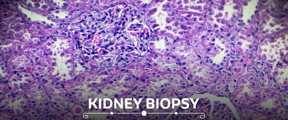 Kidney Biopsy